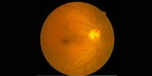 青光眼的病因是由什么引起的？北京眼科医院