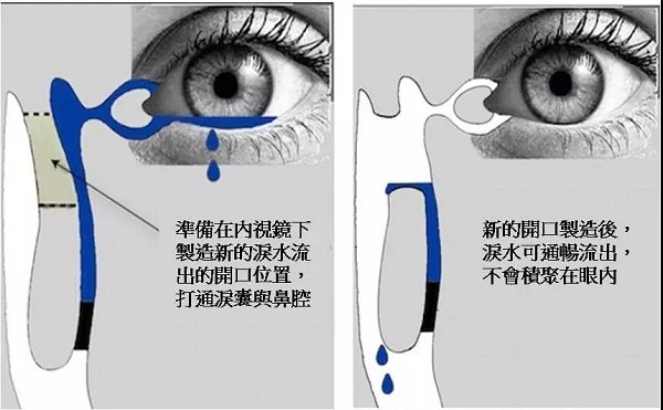 别让冷空气变成泪道病的“导火线”!