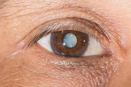 什么原因会导致眼睛白内障？