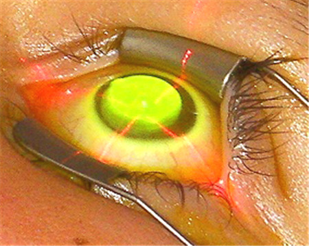 青光眼的早期症状和表现是什么？