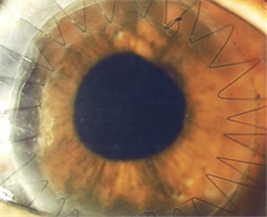 青光眼的类型有几种？