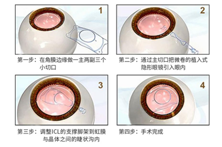 北京希玛眼科ICL晶体植入手术