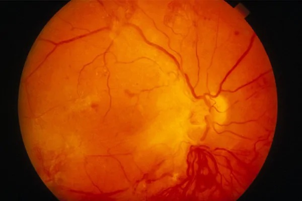 视网膜脱落不及时治疗会导致失明？