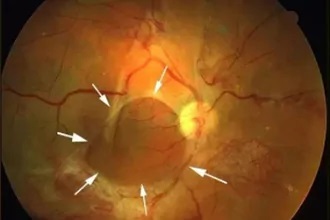 视网膜脱落手术后多久可以回复？
